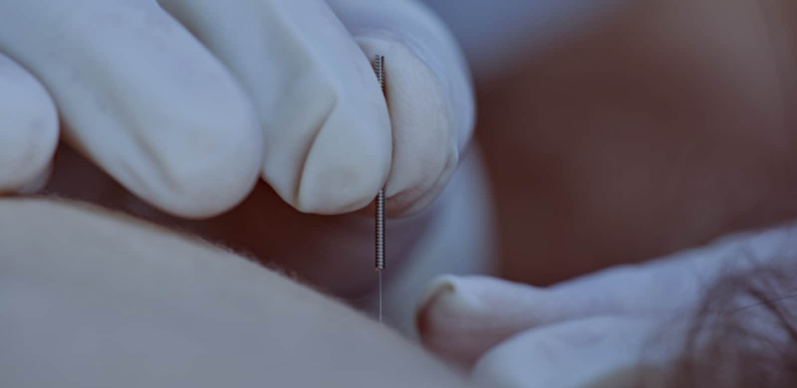 Dry Needle Therapy